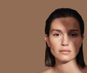 Hvad er Melasma og hvordan behandler man det - mesoestetic.dk